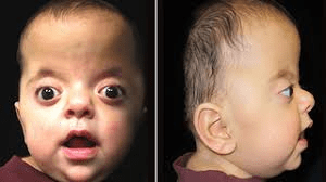 Apert Syndrome