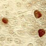 chlamydia