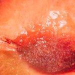Genital herpes